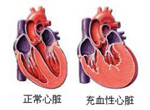 充血性心力衰竭