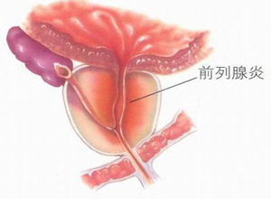 什么是前列腺炎