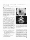 Research paper thumbnail of Adenoid cystic carcinoma of the supraglottis mimicking a laryngeal cyst