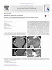 Research paper thumbnail of Massive left ventricular calcification