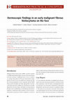 Research paper thumbnail of Dermoscopic findings in an early malignant fibrous histiocytoma on the face