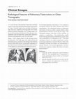 Research paper thumbnail of Radiological Features of Pulmonary Tuberculosis in Elderly Patients