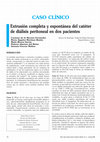 Research paper thumbnail of Extrusión completa y espontánea del catéter de diálisis peritoneal en dos pacientes