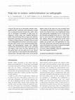 Research paper thumbnail of Pulp size in molars: underestimation on radiographs