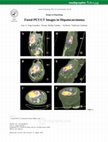 Research paper thumbnail of Fused PET/CT images in hepatocarcinoma