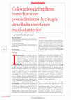 Research paper thumbnail of Colocación de implante inmediato con procedimiento de cirugía de sellado alveolar en maxilar anterior. A propósito de un caso