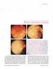 Research paper thumbnail of Multiple lymphomatous polyposis