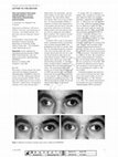 Research paper thumbnail of Wall eyed bilateral internuclear ophthalmoplegia in chronic inflammatory demyelinating polyneuropathy