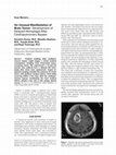 Research paper thumbnail of Anticoagulation After Coronary Artery Surgery in Patients With Polycythemia Vera: Report of Two Cases