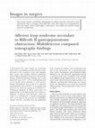 Research paper thumbnail of Afferent loop syndrome secondary to Billroth II gastrojejunostomy obstruction: Multidetector computed tomography findings