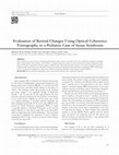 Research paper thumbnail of Evaluation of Retinal Changes Using Optical Coherence Tomography in a Pediatric Case of Susac Syndrome