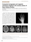 Research paper thumbnail of Computed tomography and magnetic resonance imaging in the osseous phase of Nasu-Hakola disease