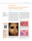 Research paper thumbnail of SkIndia Quiz 27: Rhinophyma and numerous facial papule and nodules in a 39-year-old woman