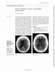 Research paper thumbnail of Recent onset of bleeding and gross coagulopathy