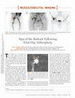 Research paper thumbnail of Sign of the Buttock Following Total Hip Arthroplasty