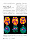 Research paper thumbnail of Putamen dopamine transporter and glucose metabolism are reduced in SCA17