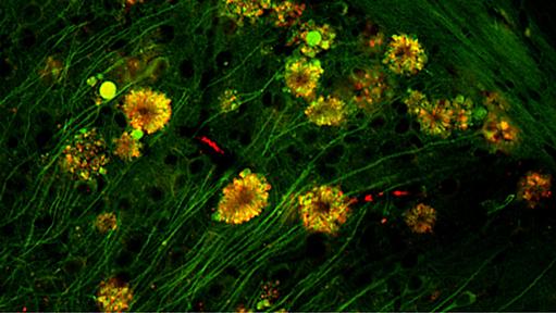 脳細胞に咲く「毒の花」がアルツハイマー病の真の原因と判明！ - ナゾロジー