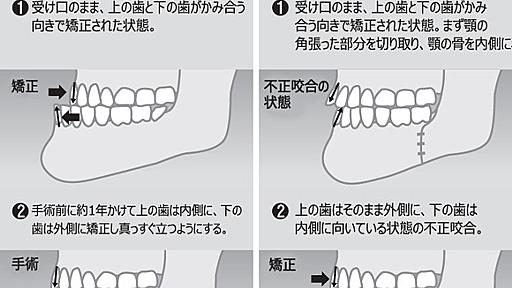 【韓国】顎削り手術の副作用続出…「商業主義」と「早く早く病」、セオリー無視した独特の手術法が原因か : ネトウヨにゅーす。