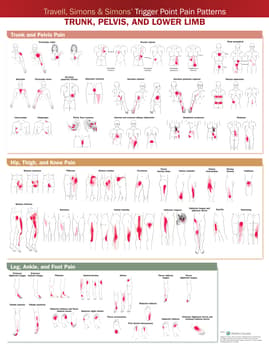 Travell, Simons & Simonsâ Trigger Point Pain Patterns Wall Chart