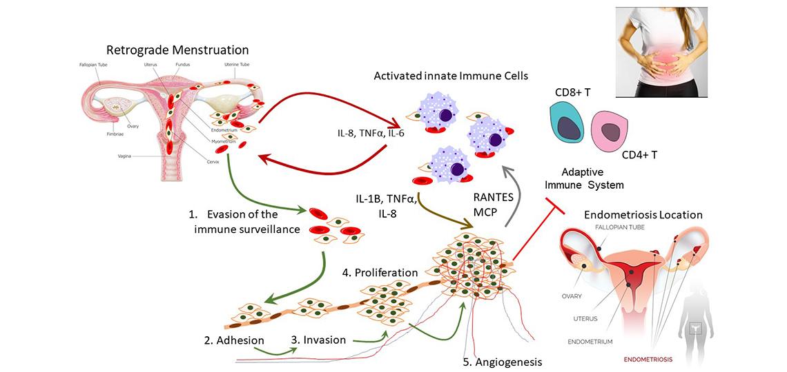 The molecular mechanism of endometriosis. It describes how endometriosis is initiated and progressed in women with endometriosis.