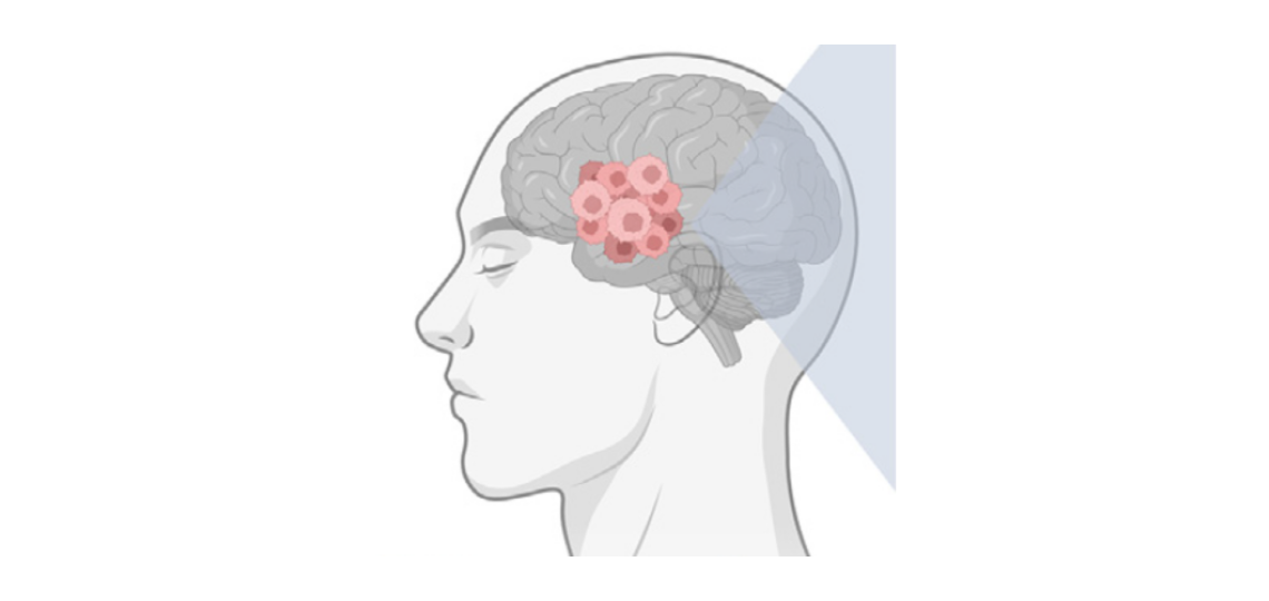 Human brain with glioma cells highlighted