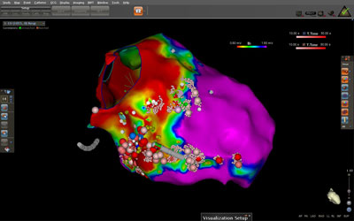 Ischemic VT voltage and treatment