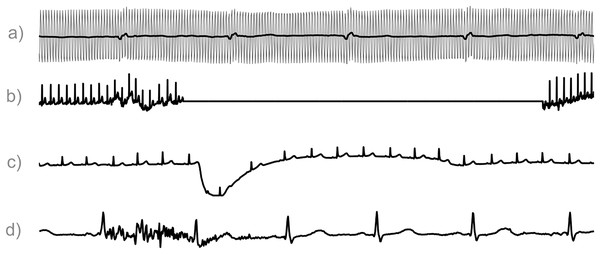 ECG Segments contaminated by artifacts.