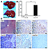 IL-33 facilitates biliary carcinogenesis.