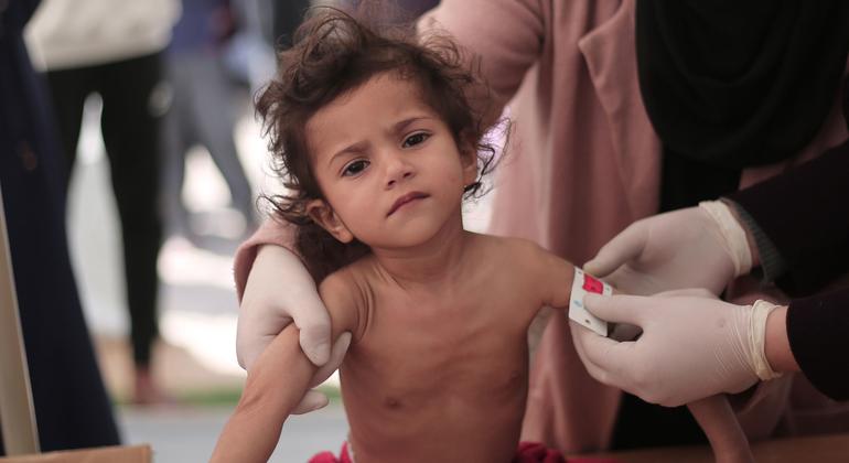 Many children in Gaza are showing signs of  severe acute malnutrition and drastic weight loss.