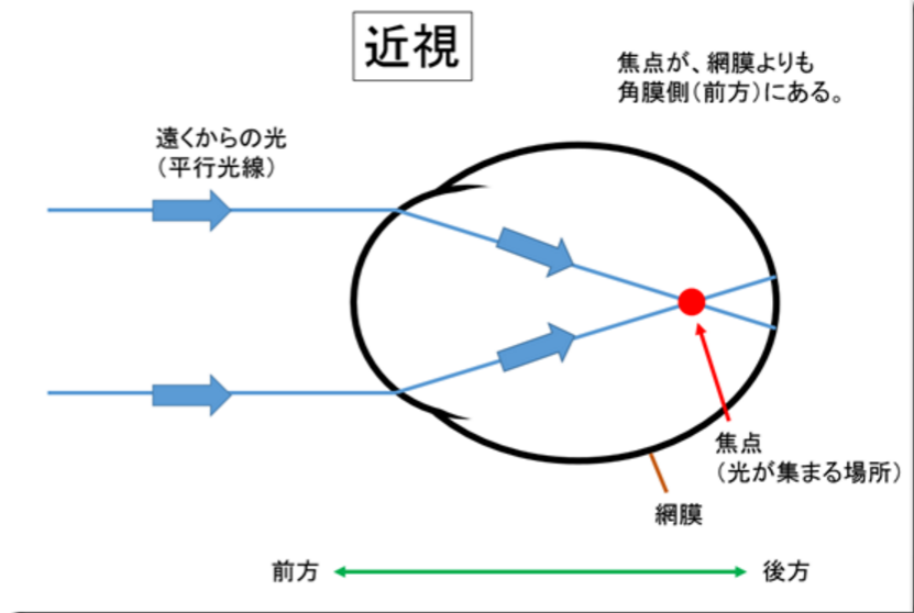 親子で学ぶ近視サイト（日本近視学会監修）