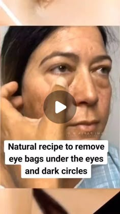 HealthTipssssss on Instagram: "NATURAL RECIPE TO REMOVE EYE BAGS UNDER remove  THE EYES AND DARK CIRCLES  Leve bags under the eyes  #darkcircles  #skin#naturalremedy circles  #womenshealth  #healthy#uganda#southafrica  #worldwide #naturalremedies" Undereye Bags Remedy, Eye Bag Remedies, Eye Bags Makeup, Dark Circles Makeup, Dark Eye Circles, Brown Spots Removal