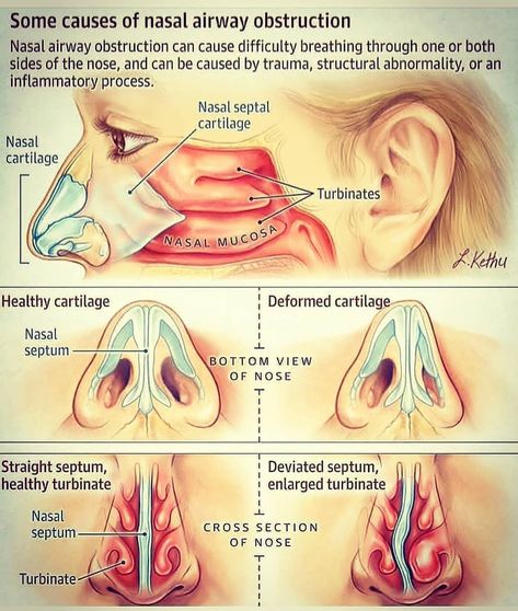 Medical Doctors on Instagram: “Nasal Airway #Obstruction . . . . . . . #med #doctor #learn #airway #nasal” Human Body Vocabulary, Med Doctor, Human Skeleton Anatomy, Basic Anatomy And Physiology, Medical Student Study, Nose Surgery, Human Body Anatomy, Medical Facts, Medical School Essentials