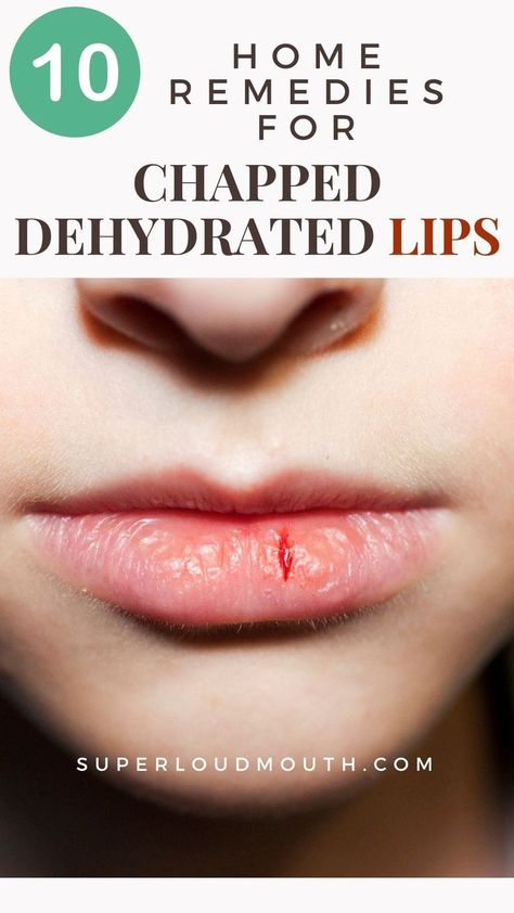 10 Home remedies you can try for dry and dehydrated Lips Remedies For Chapped Lips, Dehydration Remedies, Dry Lips Remedy, Chapped Lips Remedy, Dehydrated Lips, Home Remedies For Skin, Lip Care Routine, Sciatic Nerve Pain, Natural Cold Remedies