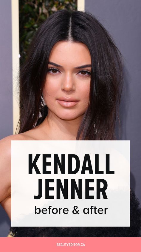 Kardashians Before And After Surgery, Kendall Jenner Before And After Surgery, Kendall Jenner Plastic Surgeries, Kendall Jenner Before And After, Celebrities Before And After Surgery, Kylie Jenner Before And After, Kybella Before And After, Kardashians Before And After, Khloe Before And After