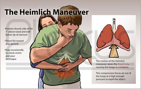 This medical illustration informs a general audience about proper Heimlich maneuver technique. Food Safety And Sanitation, Heimlich Maneuver, Health And Safety Poster, First Aid Training, Clothing Repair, Safety Poster, Safety Posters, Being A Nurse, Medical Training