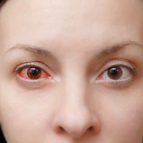 Close up of one annoyed red blood and health eye of female affected by conjunctivitis or after flu cold or allergy in... Treating Pink Eye, Pinkeye Remedies, Allergy Eyes, Cold Or Allergies, Eye Twitching, Irritated Eye, Eye Vitamins, Eye Infections, Watery Eyes