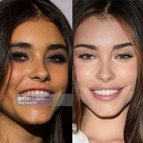 Madison Beer plastic surgery before and after Angelina Jolie Lip Filler, Madison Beer Lip Fillers, Madison Beer Lips, Madison Beer Plastic Surgery, Jaw Filler, Lip Lift Surgery, Botox Lip Flip, Filler Face, Angelina Jolie Lips