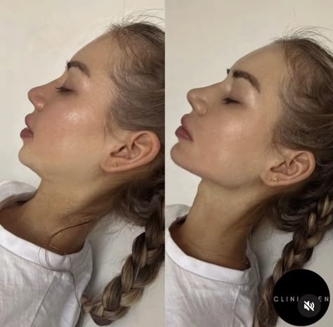 Jawline Before And After, Jaw Implant Before And After, Facial Contouring Fillers, Chin And Jawline Fillers, Facial Balancing Before And After, Square Jaw Reduction, Jawline Surgery, Chin Fillers Before After Round Face, Chin Implant Before And After Women