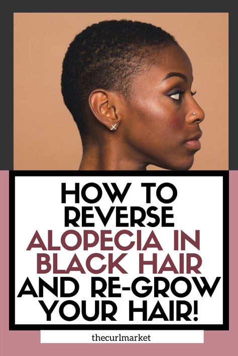 Alopecia Hair Growth, Alopecia Hairstyles, Healthy Natural Hair Growth, Hair Growing Tips, How To Grow Natural Hair, Hair Remedies For Growth, Bald Spot, Regrow Hair, Healthy Natural Hair