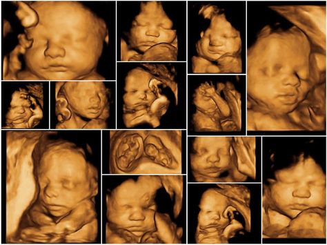 A new article claims that the heartbeats of unborn babies are "imaginary" and that unborn babies aren't really alive. 4d Ultrasound Pictures, Angel Prints, 3d Ultrasound, Care During Pregnancy, 4d Ultrasound, Ultrasound Pictures, Baby Scan, Fetal Development, Life Is Precious