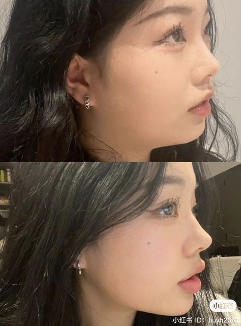 Perfect Side Profile, Face Plastic Surgery, Nose Fillers, Chin Filler, Plastic Surgery Fail, Chin Implant, Rhinoplasty Nose Jobs, Lips Inspiration, Botox Before And After