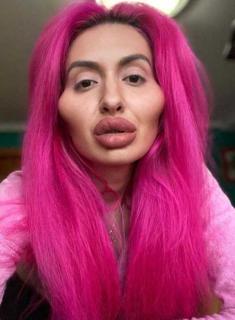 Extreme Plastic Surgery, Plastic Surgery Fail, Botox Lips, Plastic Surgery Gone Wrong, Bad Fashion, Celebrity Plastic Surgery, Celebrities Then And Now, Under The Knife, Cosmetic Procedures