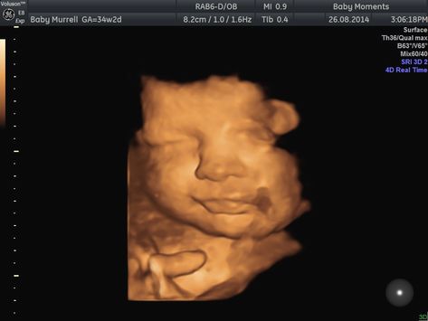 This is our 4d baby scan done our clinic Baby Moments. Look at the baby scan 16 Weeks Pregnant Belly, 16 Weeks Pregnant Ultrasound, Edwards Syndrome, Pregnancy Scan, 20 Week Scan, Medical Ultrasound, 3d Ultrasound, 4d Ultrasound, Baby Ultrasound