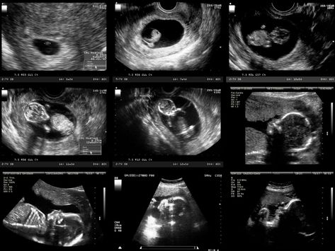 A new, high-tech MRI scan captures amazing video footage of an unborn baby having a dance party inside the womb. First Month Of Pregnancy, Pregnancy Ultrasound, Pregnancy Calculator, Pregnancy Progression, Baby Ultrasound, Ultrasound Pictures, Baby Scan, Fetal Development, Law And Justice