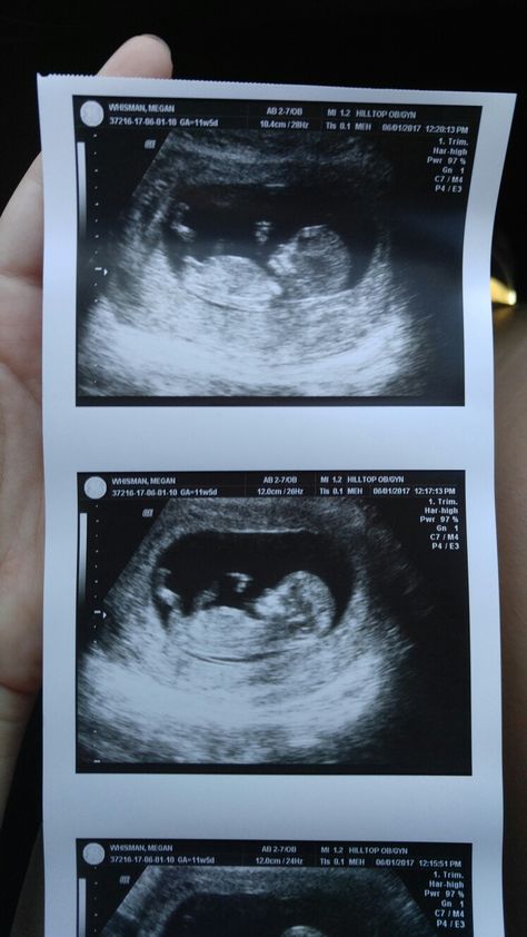 12 Week Ultrasound Pictures, Ultra Sound Pictures, 10 Week Ultrasound Pictures, 11 Week Ultrasound, 10 Week Ultrasound, Positive Pregnancy Test Pictures, 12 Week Ultrasound, Vom Avea Un Copil, 11 Weeks Pregnant