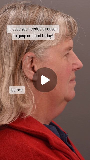 Quatela Center for Plastic Surgery on Instagram: "There is no caption that could speak louder than these images! This is LIFE CHANGING!  Surgery: facelift with deep neck work, temporal lift, upper and lower eyelid lift  Surgeon: World Renowned Double Board Certified Facial Plastic Surgeon Dr. Vito Quatela   #facelift #faceliftsurgery #faceliftspecialist #faceliftexpert #faceliftbeforeandafter #deepplanefacelift #naturalfacelift #lifechanging #plasticsurgery #plasticsurgeon" Plastic Surgery Before And After Face, Upper Eyelid Lift Surgery, Eyelid Lift Surgery Before After, Neck Lift Before And After, Lower Face Lift Before And After, Plastic Surgery Before And After, Lip Lift Surgery, Meghan Markle Plastic Surgery, Double Chin Surgery