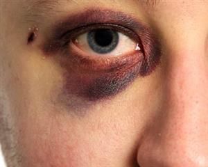 Injury Makeup, Droopy Eyelids, Fx Makeup, Stage Makeup, Zombie Halloween, Sfx Makeup, Special Effects, Photo Reference, Eye Black