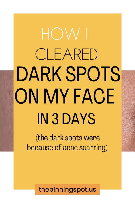 Do you know what it really take to lighten dark spots on your face? Find out in this comprehensive guide the best products & skin tips to effectively clear hyperpigmentation & acne marks. You'll find the secrets to fading acne marks naturally that cause dark spots on your face so as to achieve a flawless complexion in just three days. It's a proven 3-day routine to diminish dark spots on your face naturally, packed with skin tips and product recommendations to achieve a flawless complexion At Home Skin Treatments, Dark Marks On Face, Skin Treatments For Acne, Face Masks Skin, Spot Remover For Face, Treatments For Acne, Age Spots On Face, Dark Spots Remedies, Clear Skin Fast