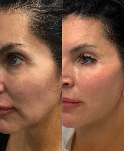 Our lovely patient looks more young  and rested after volume restoration & lower face lift with threads. Way to get natural results nonsurgically Lower Face Lift, Thread Lift Face, Face Plastic Surgery, Derma Facial, Face Threading, Facial Procedure, Face Fillers, Face Surgery, Face Lift Surgery