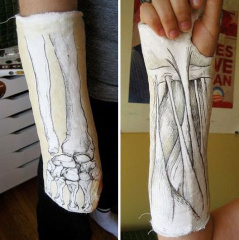 Har du skadat dig & tvingas bära gips? Lugn, bara lugn. Du kan fortfarande se cool ut. https://delbart.se/snyggt-gips-arm-ben/ Broken Hand Cast, Broken Arm Cast, Basketball Project, Writing Picture Prompts, Sisters Before Misters, Drawing Arms, Arm Cast, Shoe Art Drawing, Drawing Ideas Color